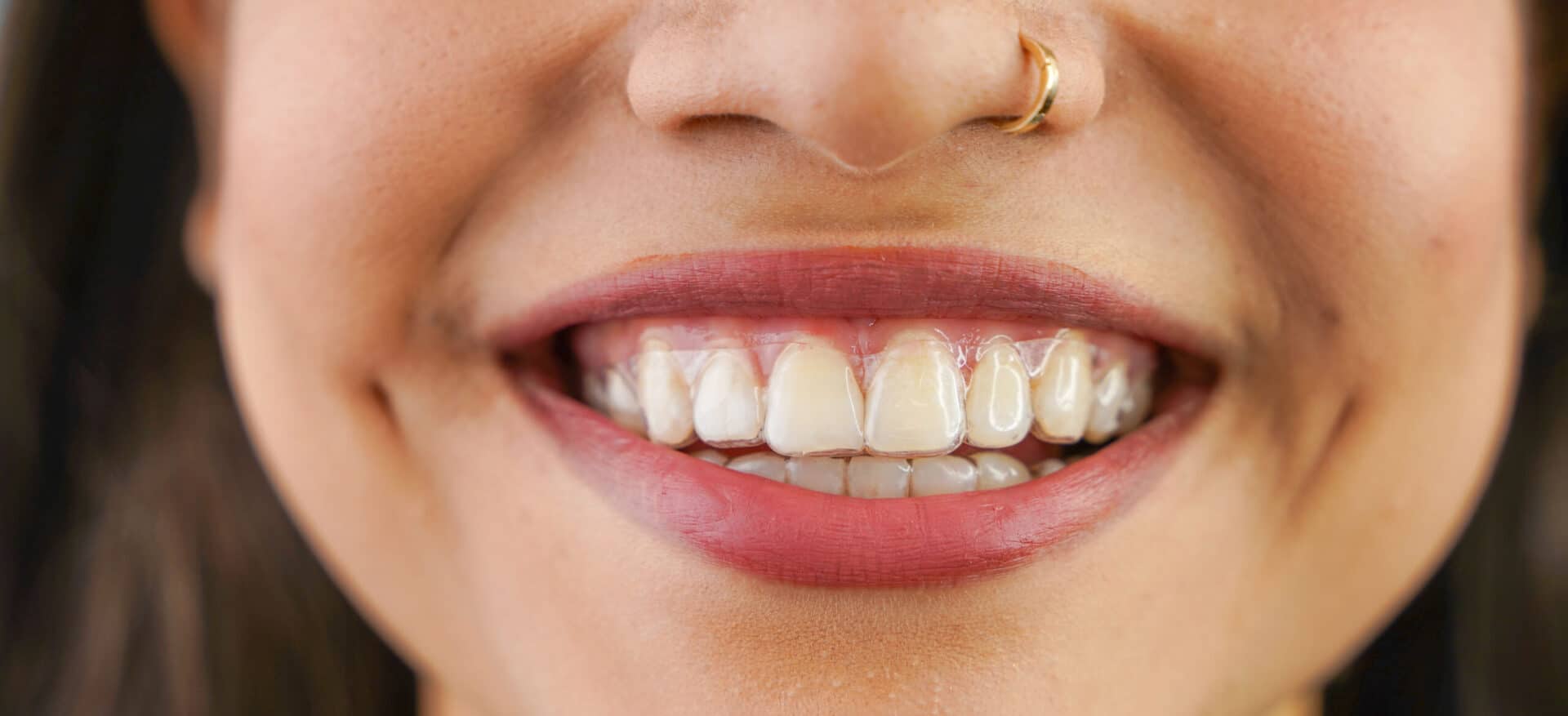 Young Asian Indian woman holding removable invisible aligner, al